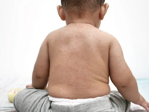 Measles vaccination