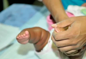 A child with clubfoot